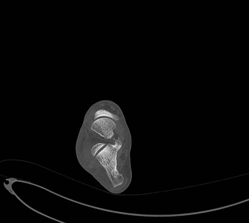 Avulsion fractures of talus and calcaneus (Radiopaedia 48277-53155 Axial bone window 42).jpg