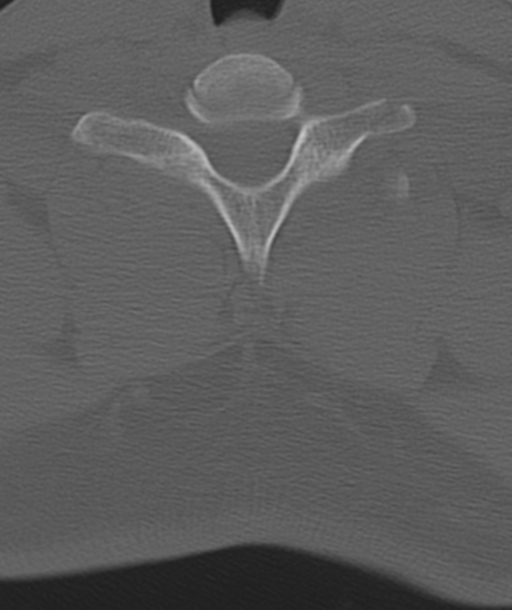 Axis peg fracture (type 3) and atlas lateral mass (type 4) fracture (Radiopaedia 37474-39324 Axial bone window 45).png