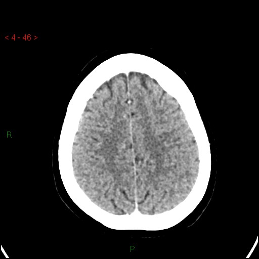 Azygos anterior cerebral artery (Radiopaedia 51987-57833 A 46).jpg