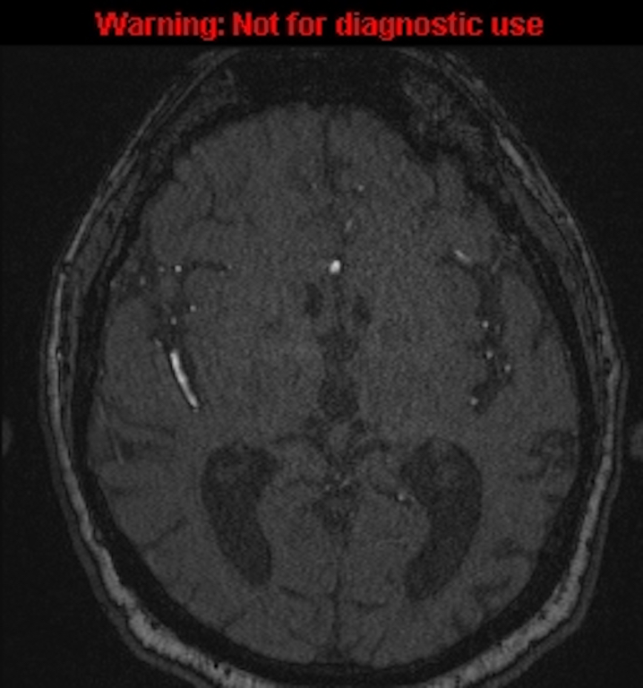 Azygos anterior cerebral artery (Radiopaedia 59325-66677 Axial MRA 86).jpg