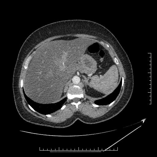 File:Azygos continuation of the IVC (Radiopaedia 40416-42965 A 19).jpg