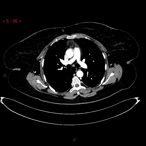 Azygos fissure and lobe (Radiopaedia 47620-52278 A 81).jpg