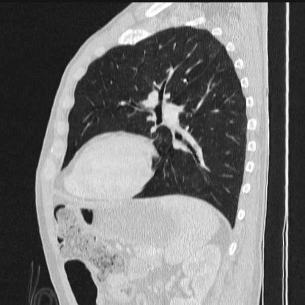 Azygos lobe (Radiopaedia 38259-40275 lung window 67).jpg