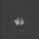 Balo concentric sclerosis (Radiopaedia 50458-55940 Axial DWI 47).jpg