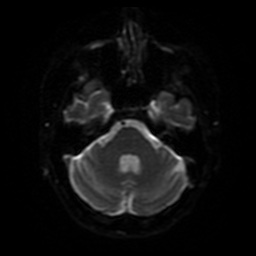 File:Balo concentric sclerosis (Radiopaedia 53875-59982 Axial DWI 31).jpg