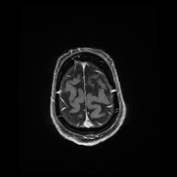 Balo concentric sclerosis (Radiopaedia 53875-59982 Axial LAVA C+ 235).jpg