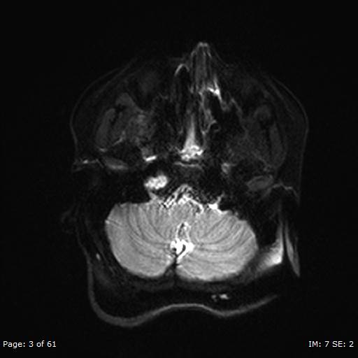 File:Balo concentric sclerosis (Radiopaedia 61637-69636 Axial DWI 3).jpg