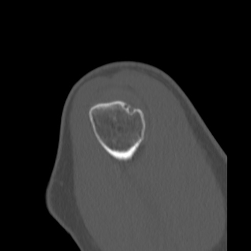 Bankart lesion (Radiopaedia 57256-64185 Sagittal bone window 7).jpg