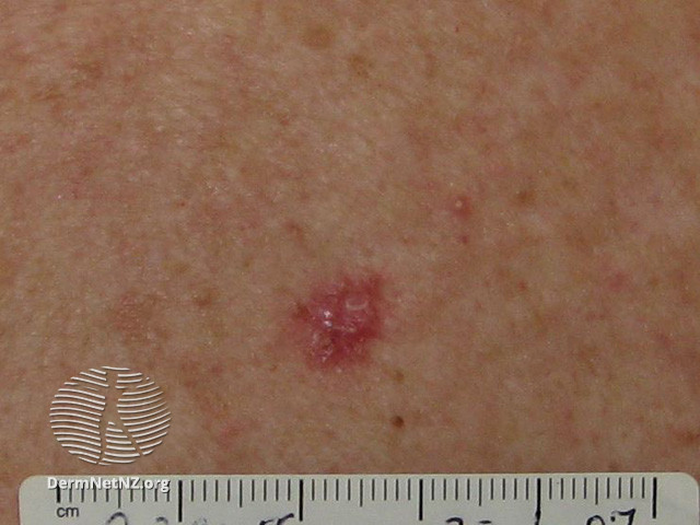 File:Basal cell carcinoma affecting the trunk (DermNet NZ lesions-bcc-trunk-0699).jpg