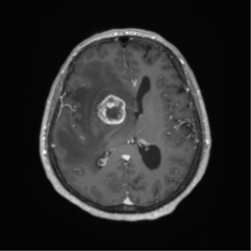 Basal ganglia metastasis (Radiopaedia 78928-91828 Axial T1 C+ 40).png