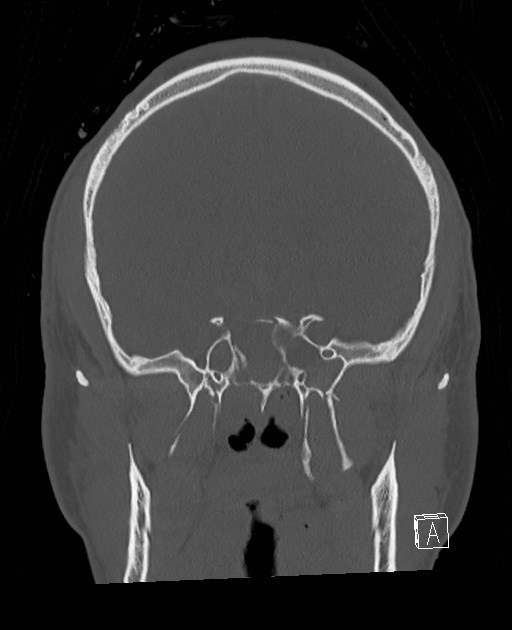 Base of skull fracture with bilateral Le Fort fractures (Radiopaedia 47094-51638 Coronal bone window 60).jpg