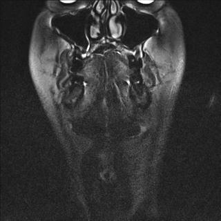 File:Base of tongue squamous cell carcinoma (Radiopaedia 31174-31884 Coronal T2 fat sat 20).jpg