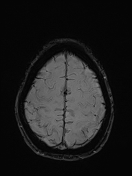 Basilar artery perforator aneurysm (Radiopaedia 82455-97733 Axial SWI 51).jpg
