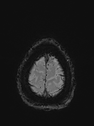 Basilar artery perforator aneurysm (Radiopaedia 82455-97733 Axial SWI 58).jpg