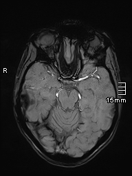 Basilar artery perforator aneurysm (Radiopaedia 82455-99523 Axial SWI 24).jpg