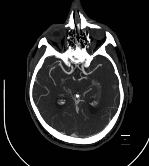 Basilar artery thrombosis (Radiopaedia 26986-27163 A 42).jpg