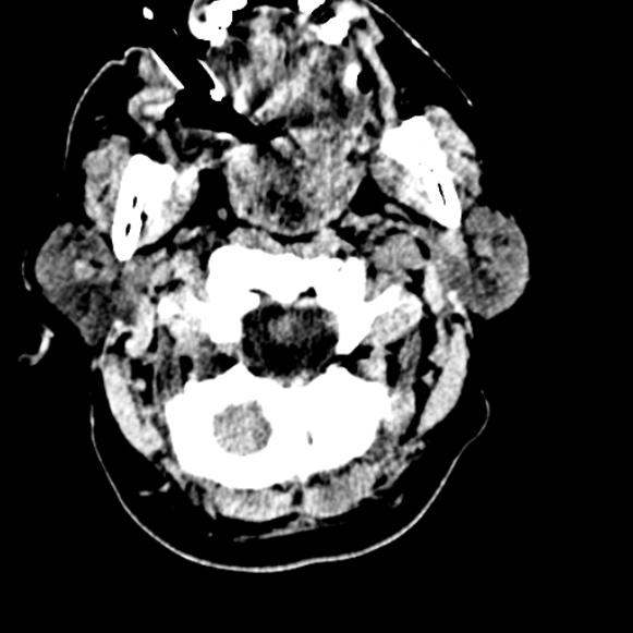 File:Basilar artery thrombosis (Radiopaedia 53351-59333 Axial non-contrast 14).jpg