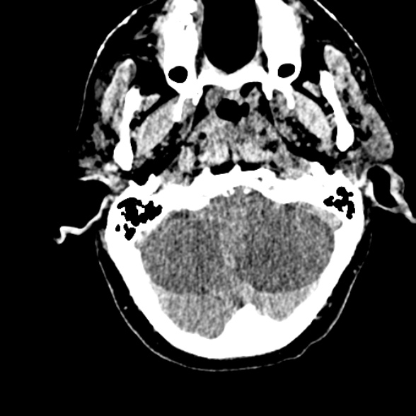 Basilar artery thrombosis (Radiopaedia 53351-59352 Axial non-contrast 26).jpg