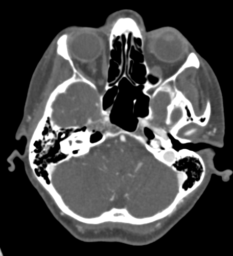 File:Basilar tip aneurysm with coiling (Radiopaedia 53912-60086 A 36).jpg