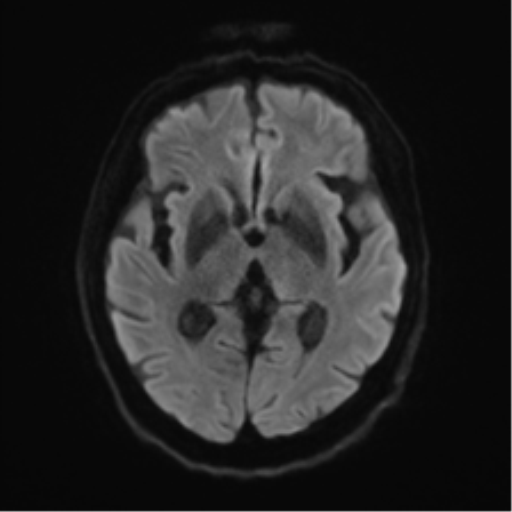 Behavioral variant frontotemporal dementia and late onset schizophrenia (Radiopaedia 52197-58083 Axial DTI Trace W 40).png