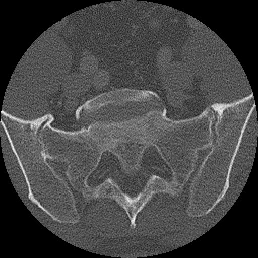 Benign post-traumatic pseudopneumoperitoneum (Radiopaedia 71199-81495 Axial bone window 289).jpg