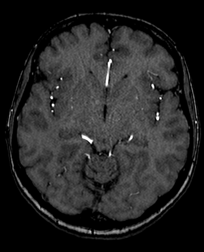 File:Berry aneurysm of the terminal internal carotid artery (Radiopaedia 88286-104918 Axial TOF 116).jpg