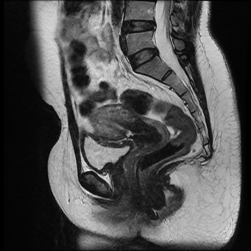 File:Bicornuate uterus (Radiopaedia 51676-57472 Sagittal T2 14).jpg
