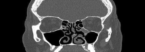 File:Bilateral Ectopic Infraorbital Nerves (Radiopaedia 49006-54084 Coronal bone window 34).jpg