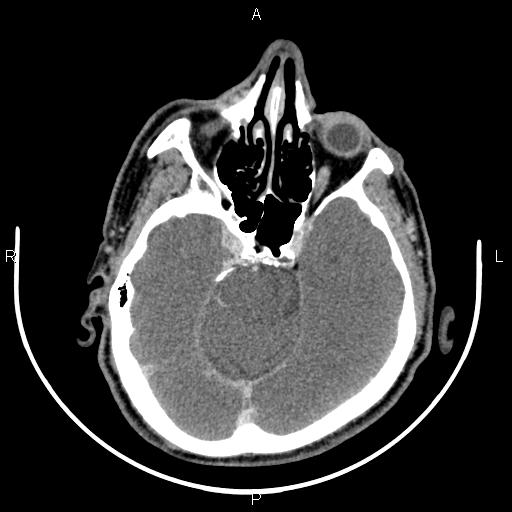 Bilateral Warthin tumors (Radiopaedia 84034-99263 Axial With contrast 1).jpg
