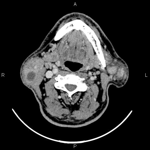 Bilateral Warthin tumors (Radiopaedia 84034-99263 Axial With contrast 32).jpg