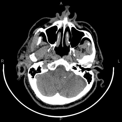 Bilateral Warthin tumors (Radiopaedia 84034-99263 Axial non-contrast 8).jpg