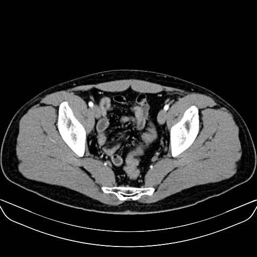 Bilateral accessory renal arteries with mild pelvi-ureteric junction (PUJ) obstruction (Radiopaedia 66357-75596 A 63).jpg