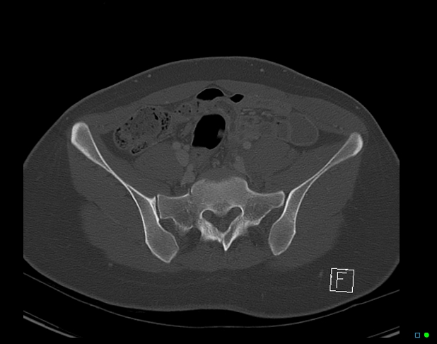 Bilateral acetabular fractures (Radiopaedia 79272-92308 Axial bone window 17).jpg