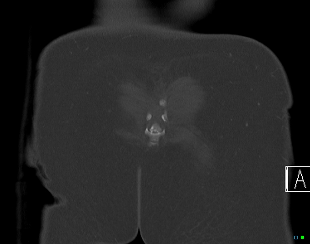 File:Bilateral acetabular fractures (Radiopaedia 79272-92308 Coronal bone window 47).jpg