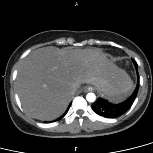 Bilateral adrenal gland hyperenhancement in pancreatitis (Radiopaedia 86642-102753 B 15).jpg