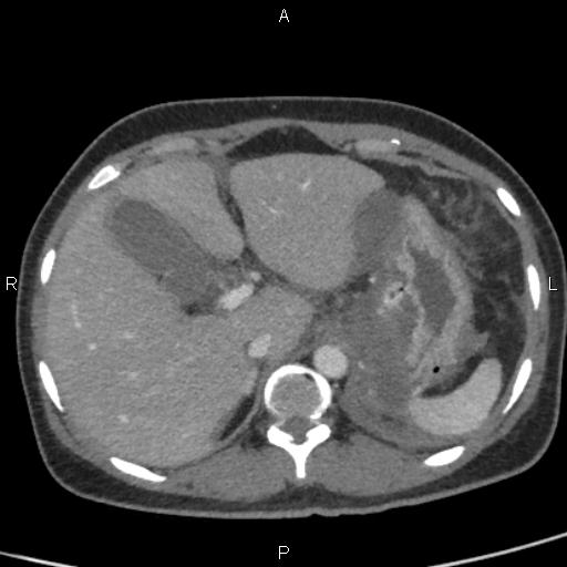 File:Bilateral adrenal gland hyperenhancement in pancreatitis (Radiopaedia 86642-102753 E 22).jpg