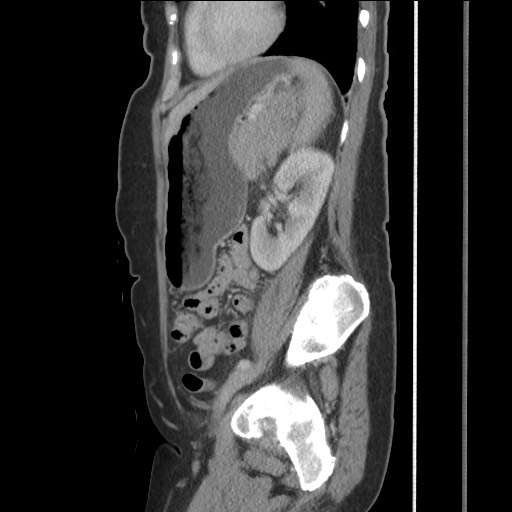 Bilateral adrenal granulocytic sarcomas (chloromas) (Radiopaedia 78375-91007 C 96).jpg