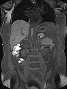File:Bilateral adrenal myelolipoma (Radiopaedia 63058-71537 Coronal T1 fat sat 53).jpg
