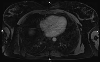 Bilateral adrenal myelolipoma (Radiopaedia 63058-71537 G 4).jpg