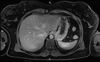 File:Bilateral adrenal myelolipoma (Radiopaedia 63058-71537 H 19).jpg