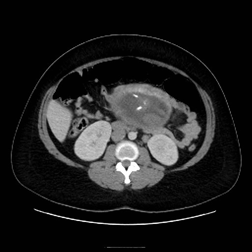 Bilateral adrenal thrombosis (Radiopaedia 58182-65256 A 35).jpg