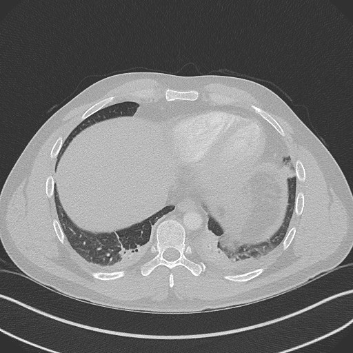 Bilateral atelectasis (Radiopaedia 48666-53675 Axial lung window 88).jpg