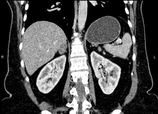 Bilateral benign adrenal adenomas (Radiopaedia 86912-103124 D 42).jpg
