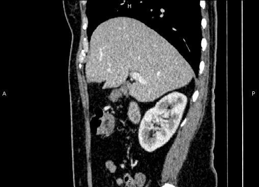 Bilateral benign adrenal adenomas (Radiopaedia 86912-103124 E 29).jpg