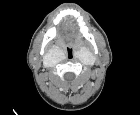 Bilateral carotid body tumors (Radiopaedia 61841-69870 Axial Post contrast 32).jpg