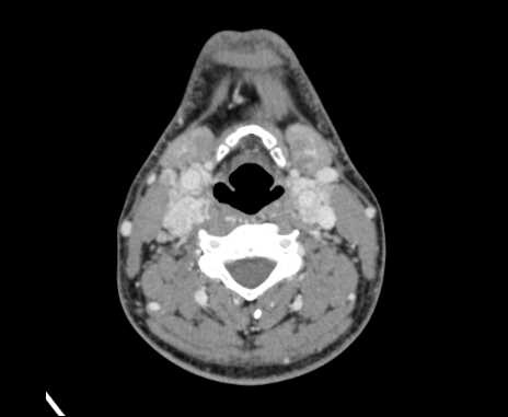 File:Bilateral carotid body tumors (Radiopaedia 61841-69870 Axial Post contrast 57).jpg