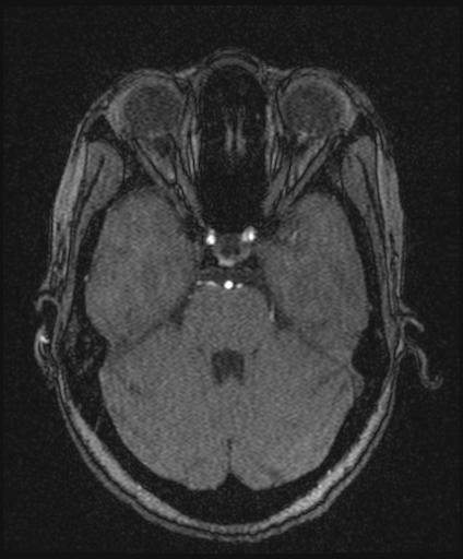 Bilateral carotid body tumors and right glomus jugulare tumor (Radiopaedia 20024-20060 Axial MRA 58).jpg