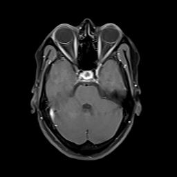 File:Bilateral carotid body tumors and right jugular paraganglioma (Radiopaedia 20024-20060 Axial 112).jpg