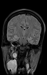 File:Bilateral carotid body tumors and right jugular paraganglioma (Radiopaedia 20024-20060 Coronal 53).jpg