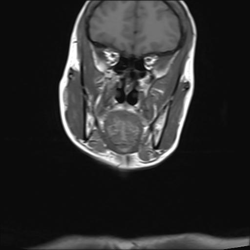File:Bilateral carotid body tumors and right jugular paraganglioma (Radiopaedia 20024-20060 Coronal 7).jpg